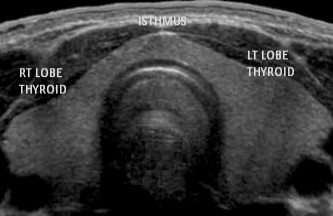 Thyroid Ultrasound scan image with labels
