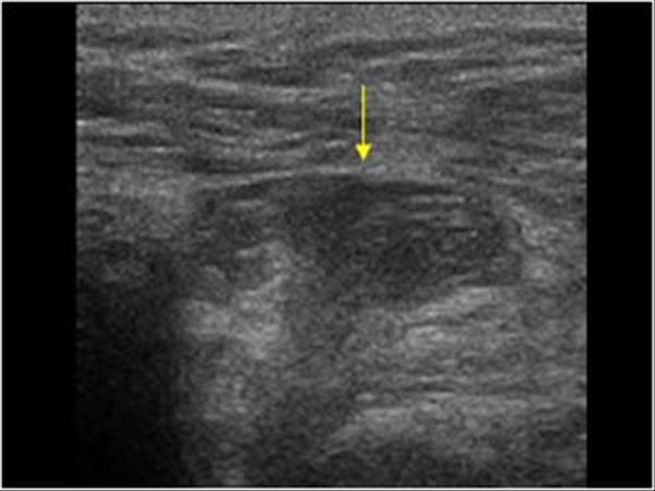 Right Kidney as seen on Ultrasound Examination