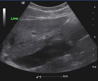 Ultrasound image of the Left lobe of Liver