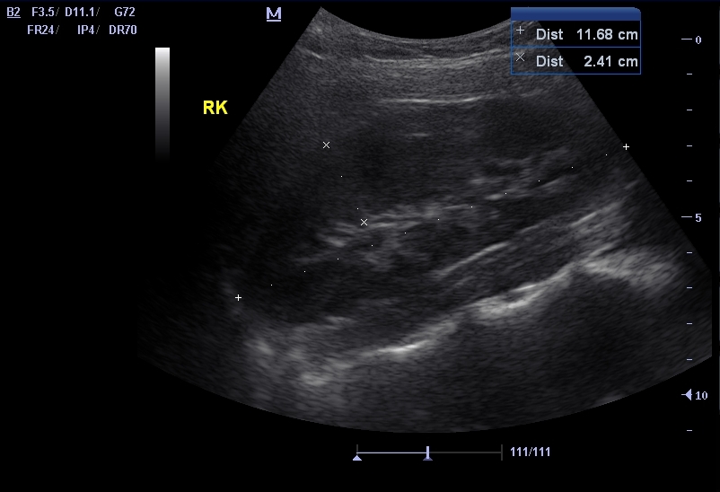 Right Kidney as seen on Ultrasound Examination