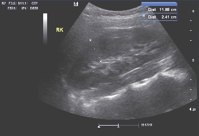 Ultrasound the Kidneys, Ureters & Bladder (KUB)