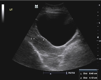 Ultrasound Image of Uterus in longitudinal section