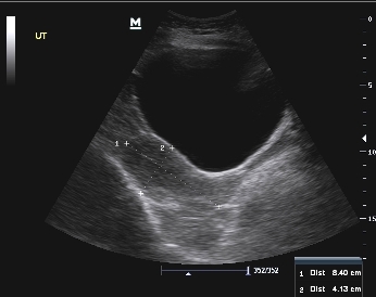 Right Kidney as seen on Ultrasound Examination