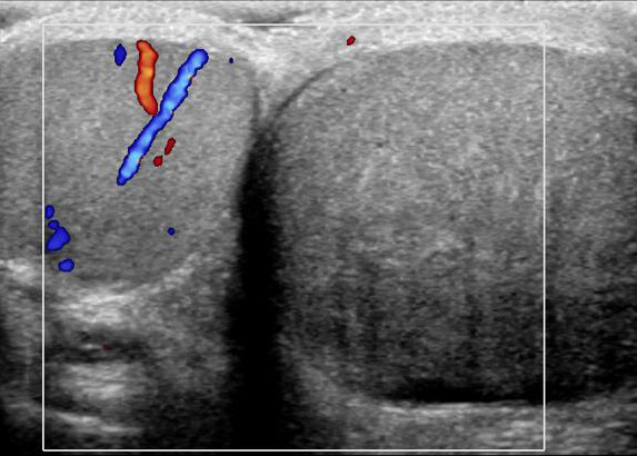 Right Kidney as seen on Ultrasound Examination